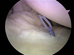 Labral Repair